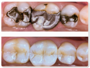 White Filling Treatment by Best Dentist of Richmond
